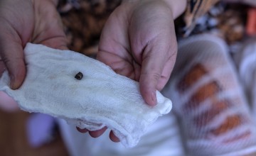 Ina Trofimenko, 47, was injured by shrapnel in her hometown Mykolaiv where fighting has been raging in the past week. Photo: Stefanie Glinski/Concern Worldwide